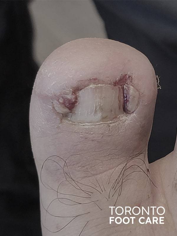 Video of a triangle cut- ingrown toenail removal ( right big toe, 54  seconds) : Weirdbutneat : r/Ingrown_Toenails