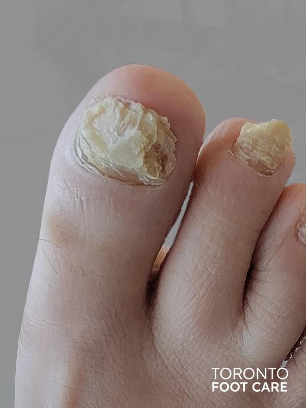 Permanent Toenail Removal | Toronto Foot Care