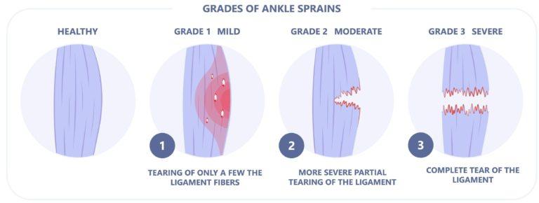 Acute ankle sprain in athletes: Clinical aspects and algorithmic approach