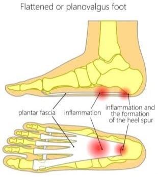 Plantar Fasciitis Causes and Treatment | Toronto Foot Care