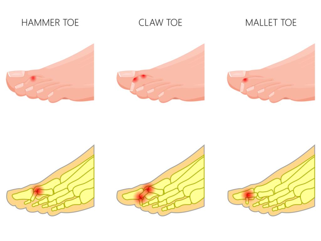 Hammer Toes & Claw Toes | Toronto Foot Care